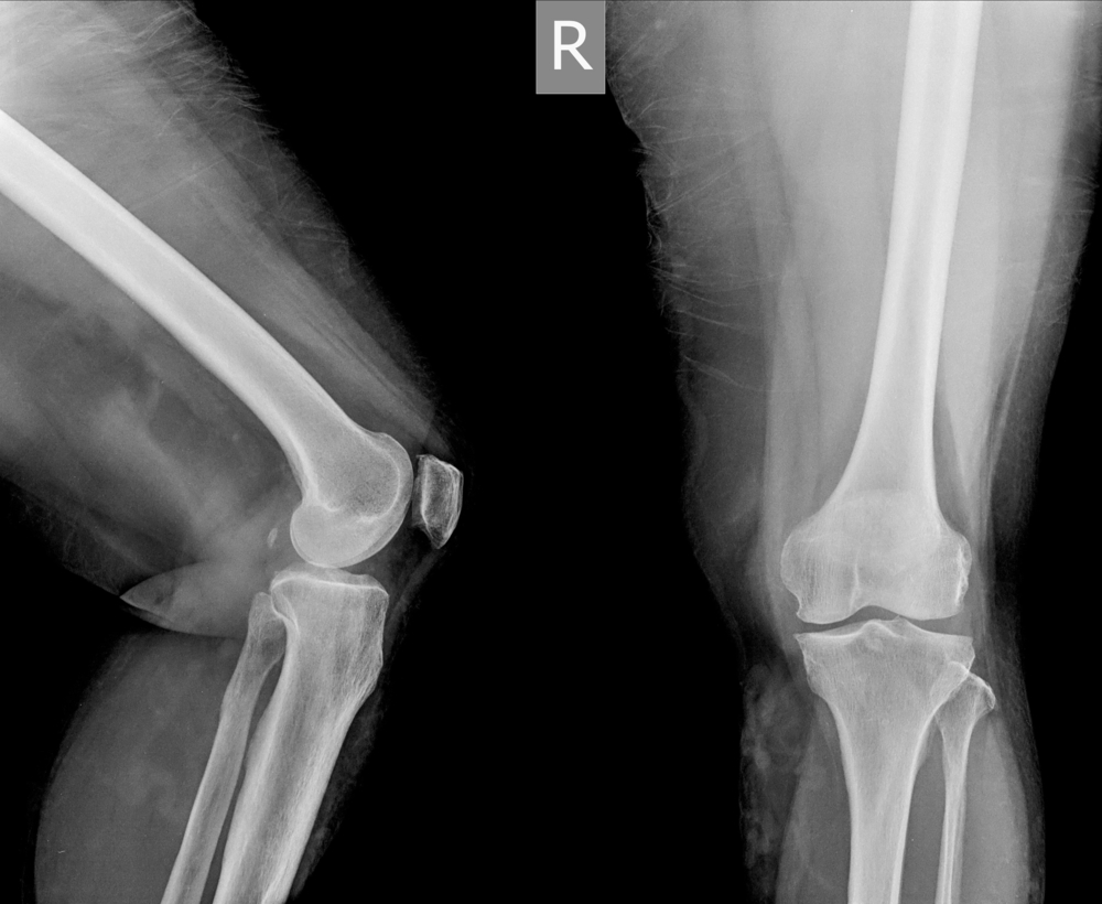 Normale knie
